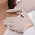 Skin Tag Removal Birmingham