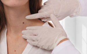 Skin Tag Removal Birmingham